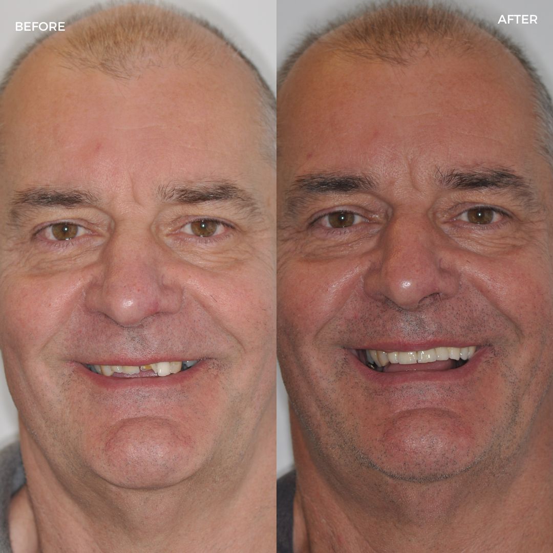 Full mouth rehab with fixed and removable prostheses