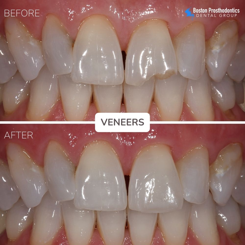 Porcelain Veneers Before & After
