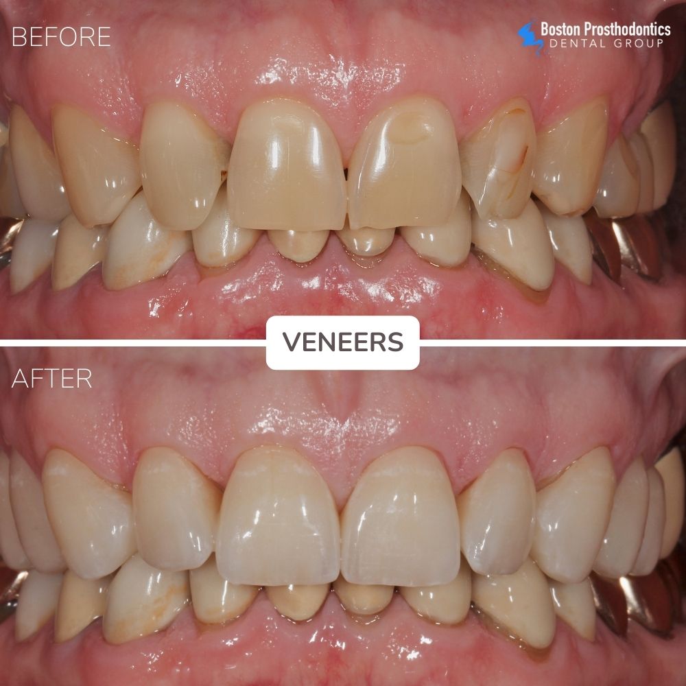 Porcelain Veneers Before & After