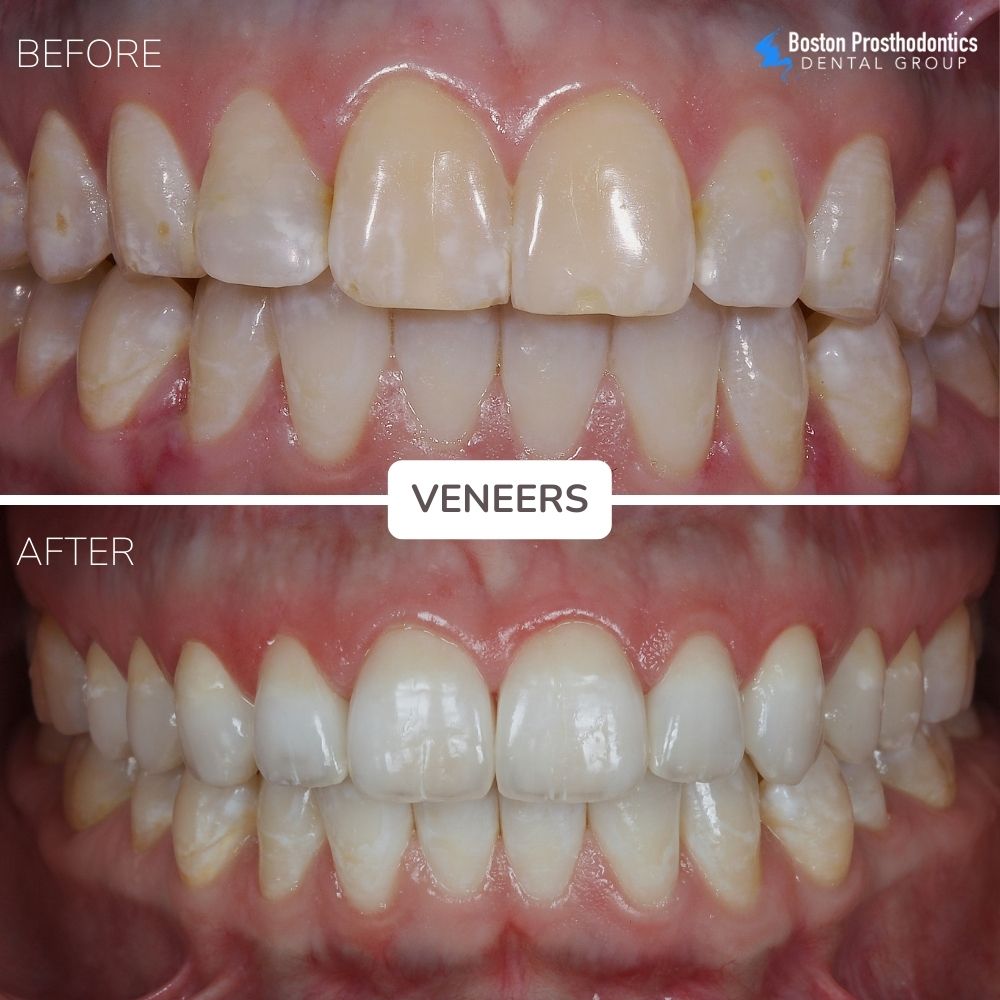 Porcelain Veneers Before & After